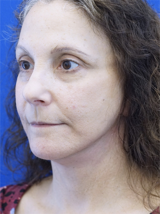 Deep Plane Facelift and Platysmaplasty — After
