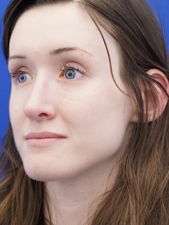 Nasal Profile Irregularity — After