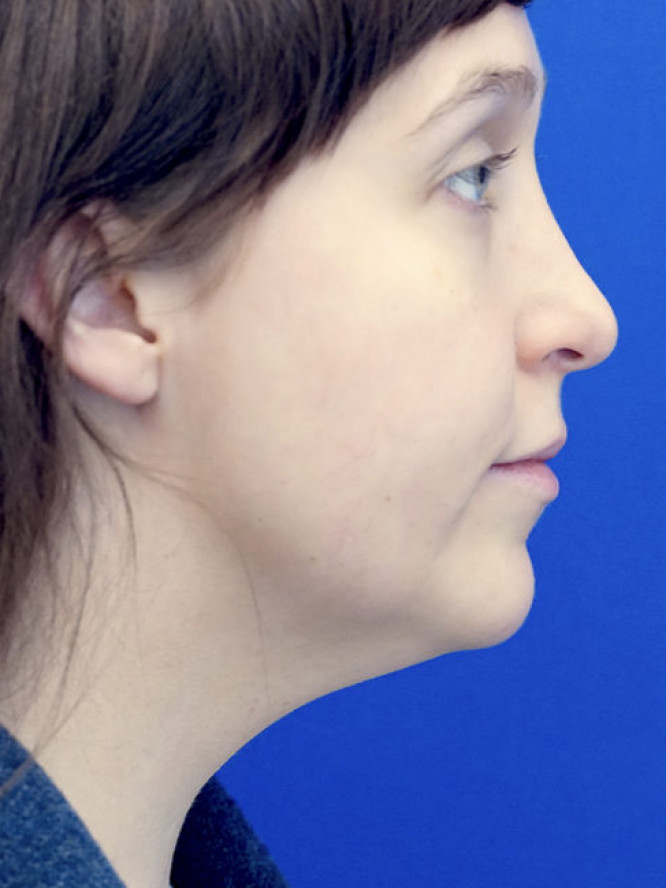 Necklift Subplatysmal Lipectomy — Before