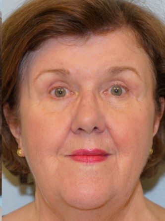 Upper Eyelid Skin Excess2* — After