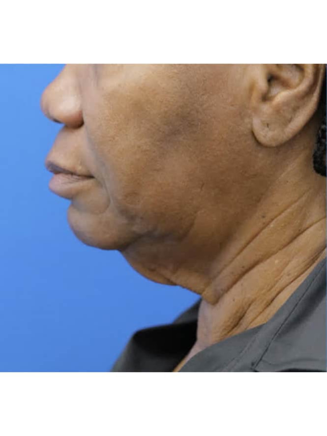Necklift with Platysmaplasty — Before