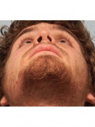 Nasal Fracture – Nostril Asymmetry* — Before