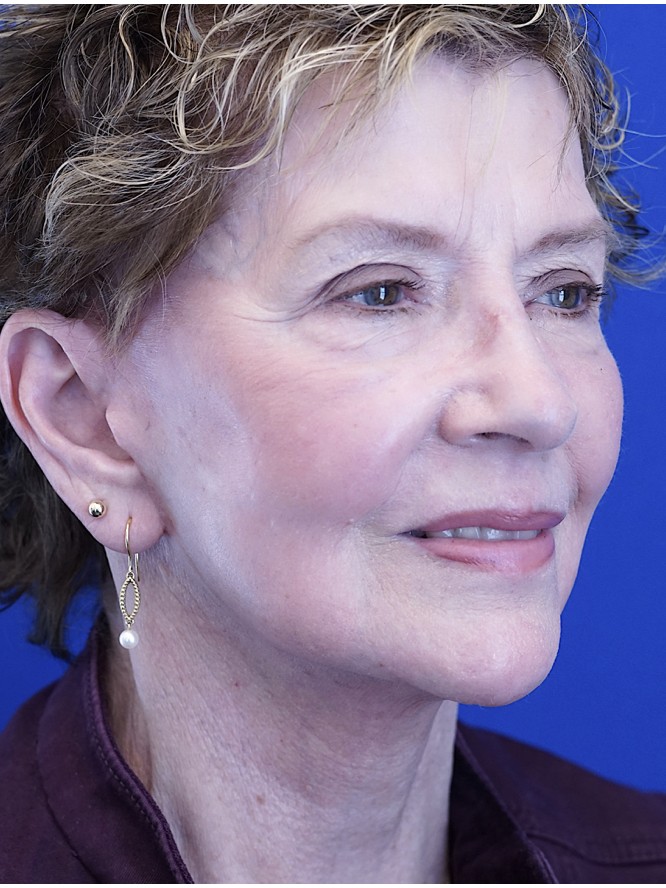 Deep Plane Facial Rejuvenation — After