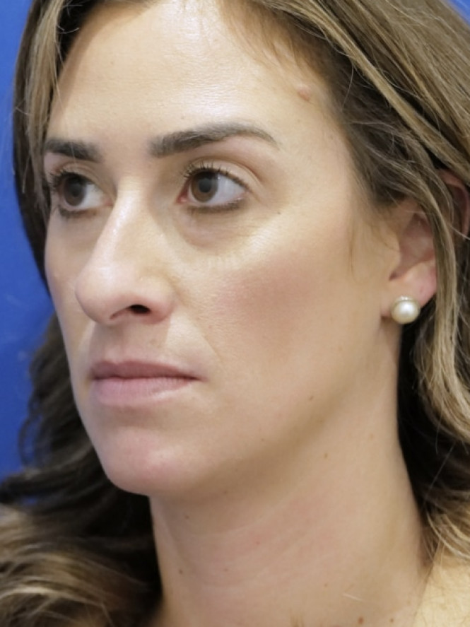 Preservation Rhinoplasty — Before