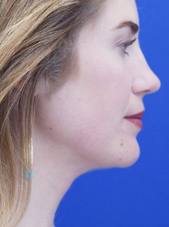 Chin LipoSculpture* — After