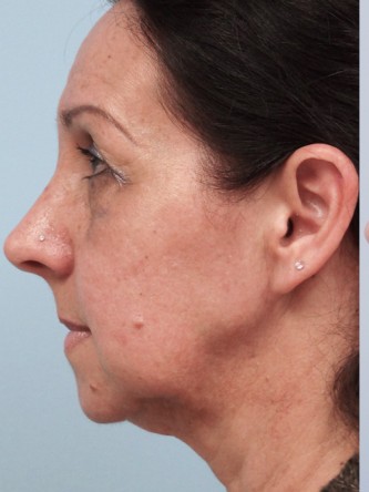 Aging Eyelid Rejuvenation, Facelift, Necklift 2* — Before