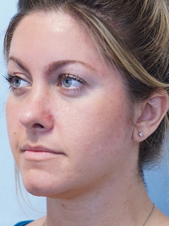 Boxy Tip Endonasal Rhinoplasty* — After