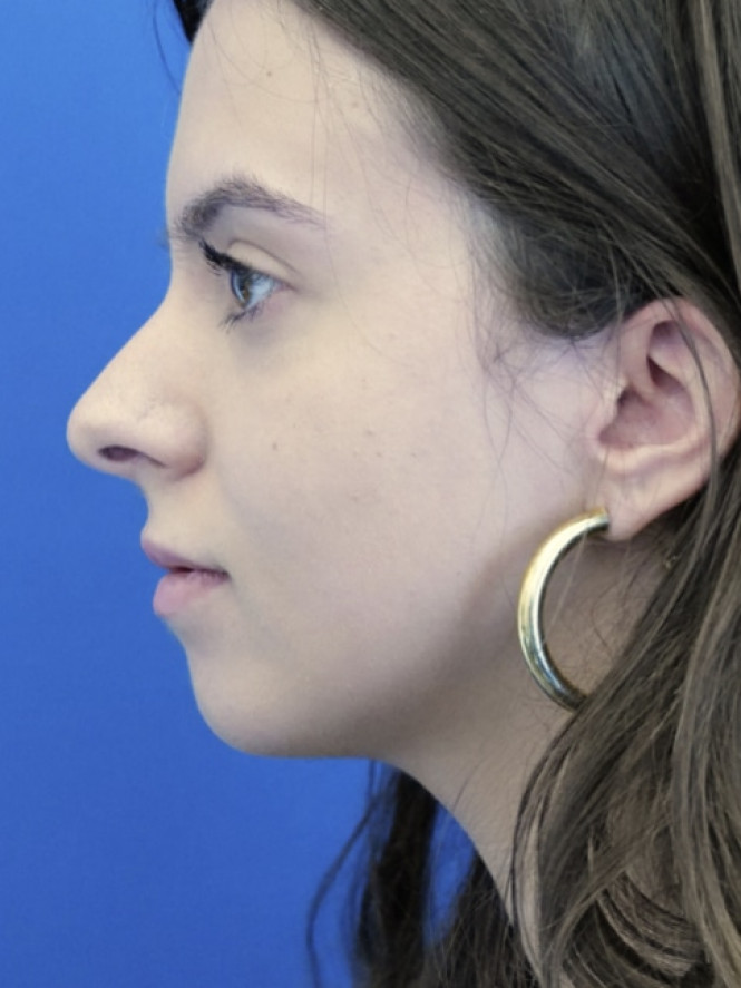 Preservation Rhinoplasty2 — Before