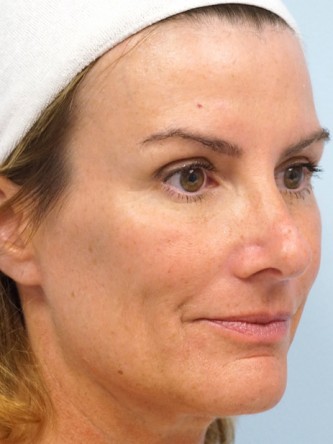 Voluma to Malar Cheek* — After