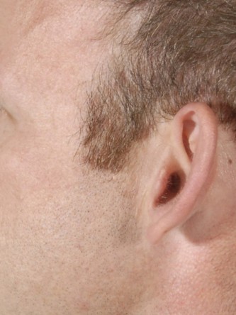 Protruding Ears – Moderate* — Before