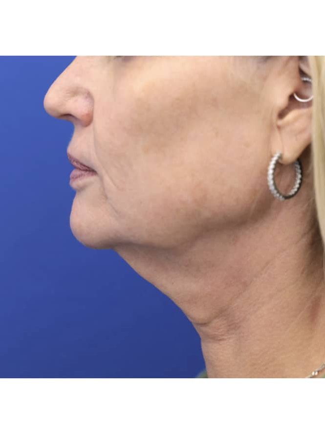 Crisp Profile Lines — Before