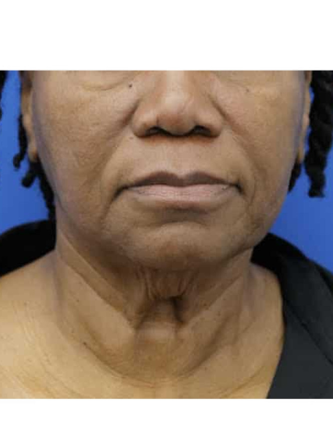 Necklift with Platysmaplasty — Before