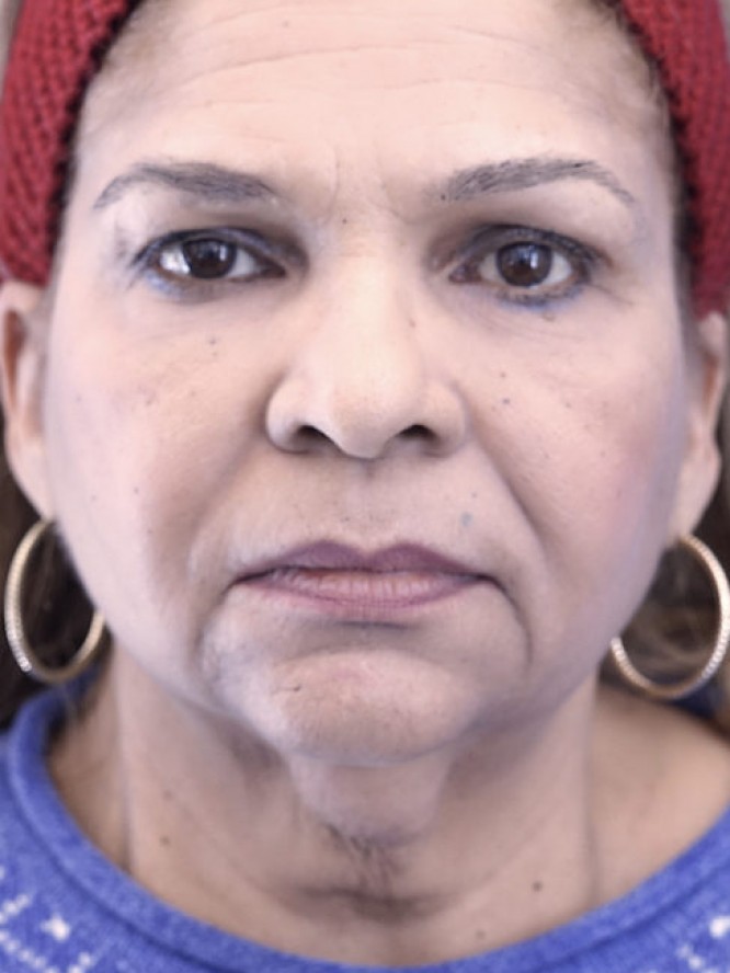 Necklift and Liposuction — Before