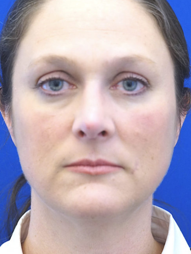 Nasal Profile Femininity — After