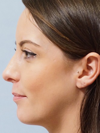 Repair of Nasal Septal Perforation* — After