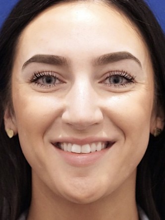 Nasal Hump Closed Rhinoplasty — Before