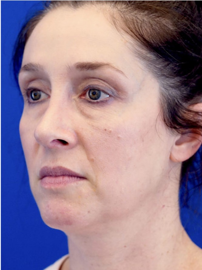 Nasal Aesthetic Nuances — After