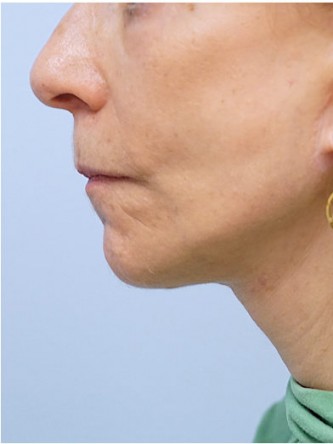Full Face and Necklift, Upper and Lower Eyelid, Browlift* — After
