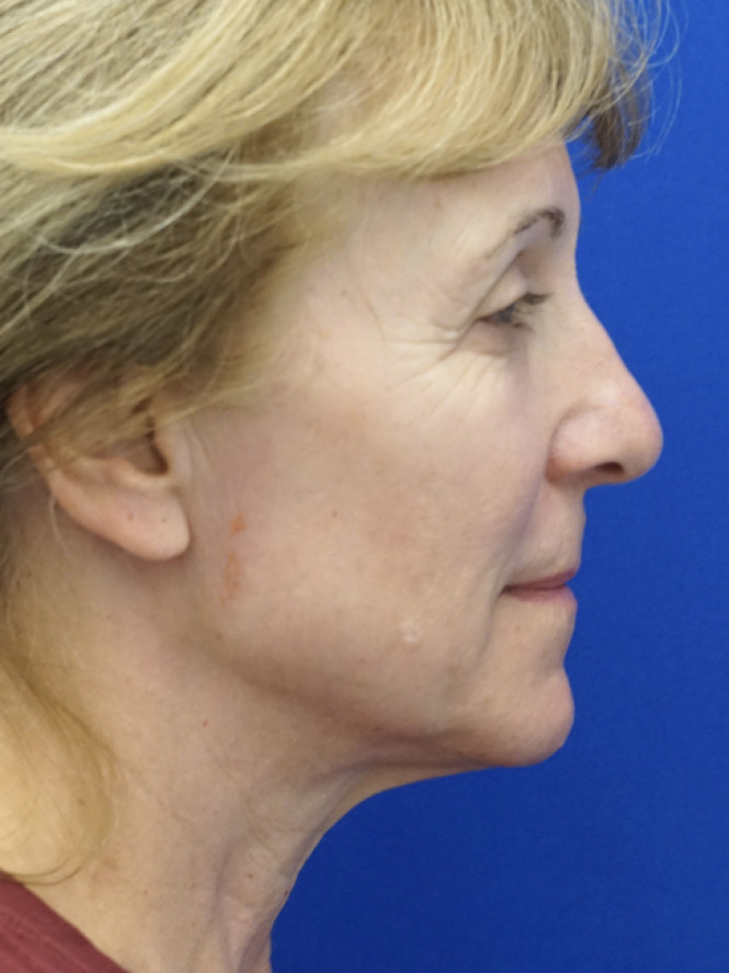 Hairline Browlift — Before