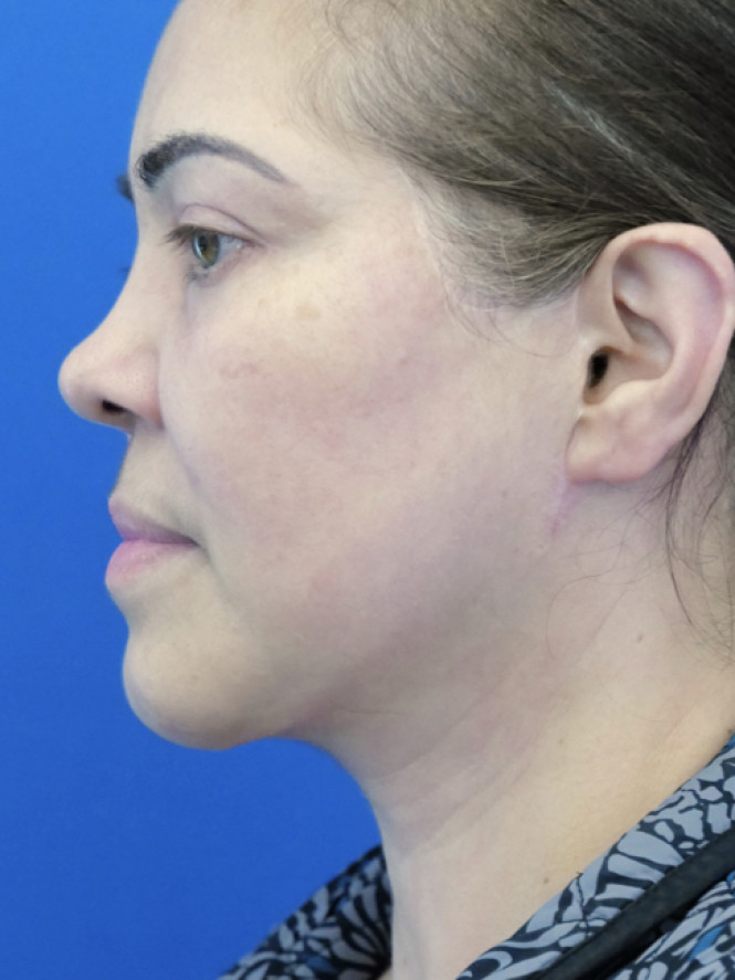 Deep Plane 2 Years Result — After