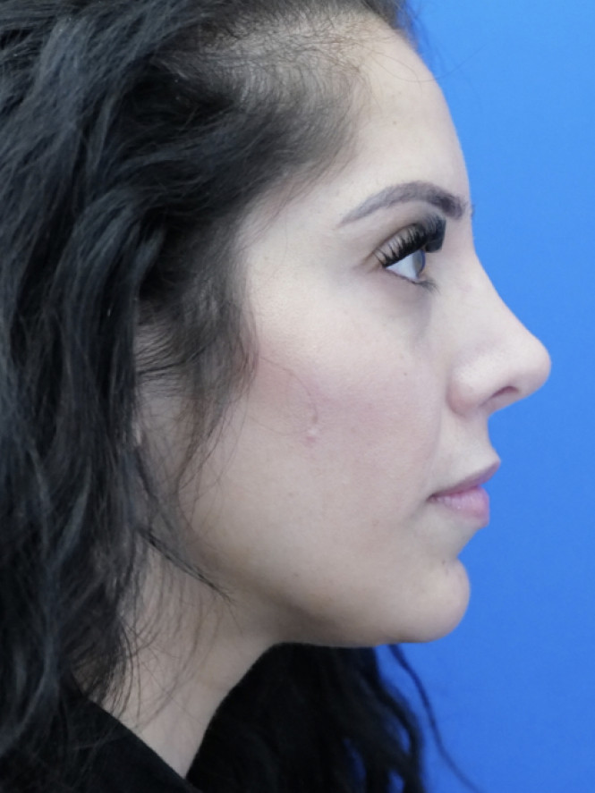 Dorsal Hump and Thick Skin — After