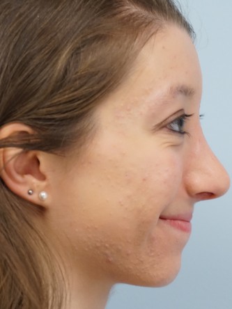 Prominent Nose Closed Rhinoplasty* — After