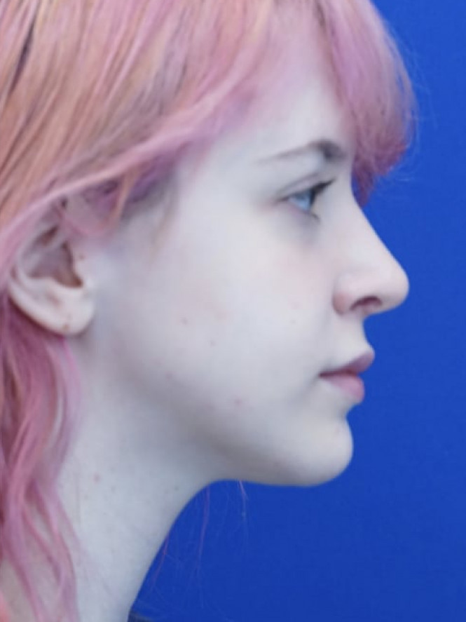 Long Droopy Tip — After
