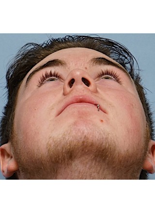 Crooked Nose Endonasal Technique3* — Before