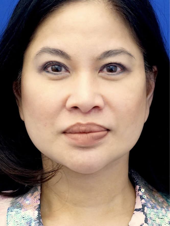 Brow Asymmetry — After