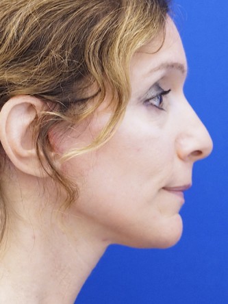 Mild Neck Skin Laxity — After