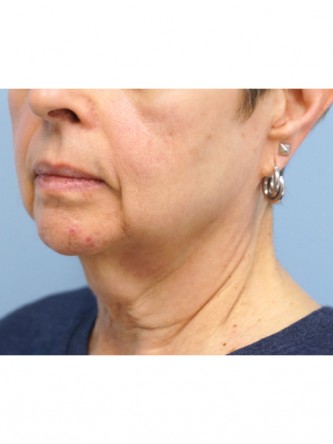 Neck Lift* — Before