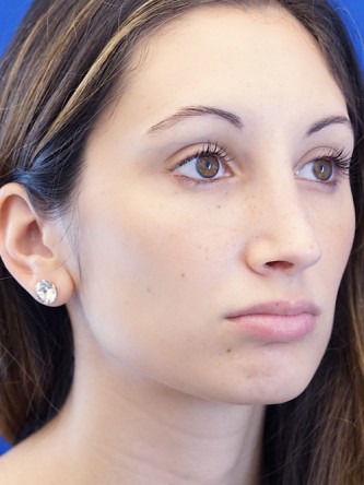 Nasal Profile Aesthetics — After