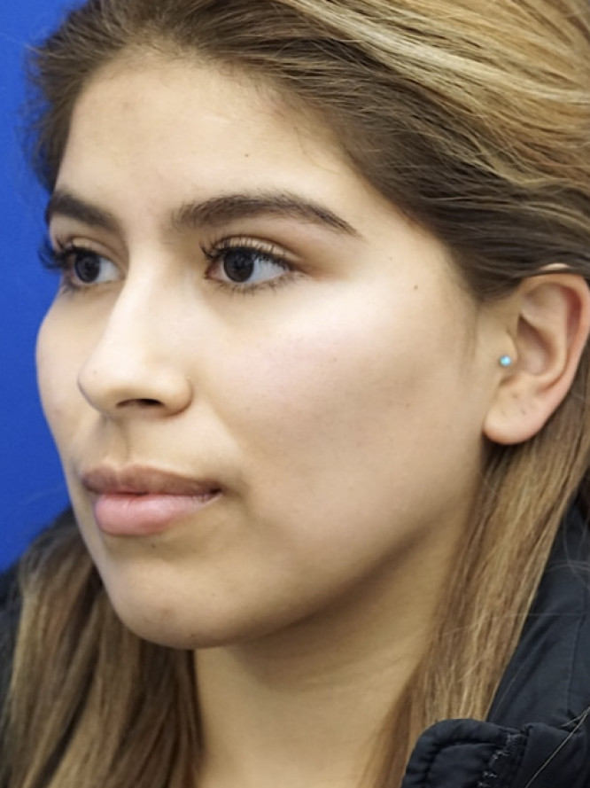 Cheek Contouring — After