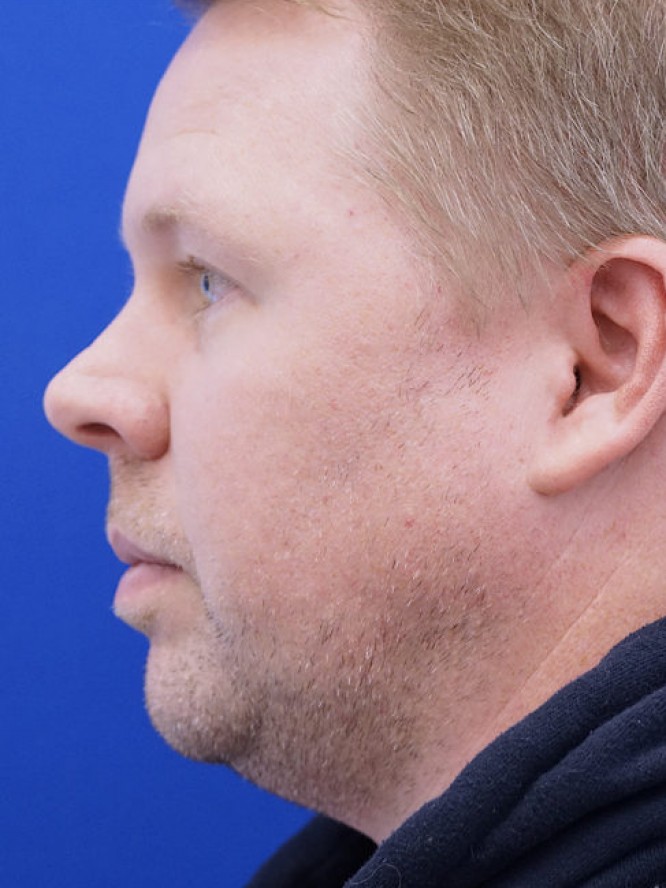 Mild Nasal Deviation — Before