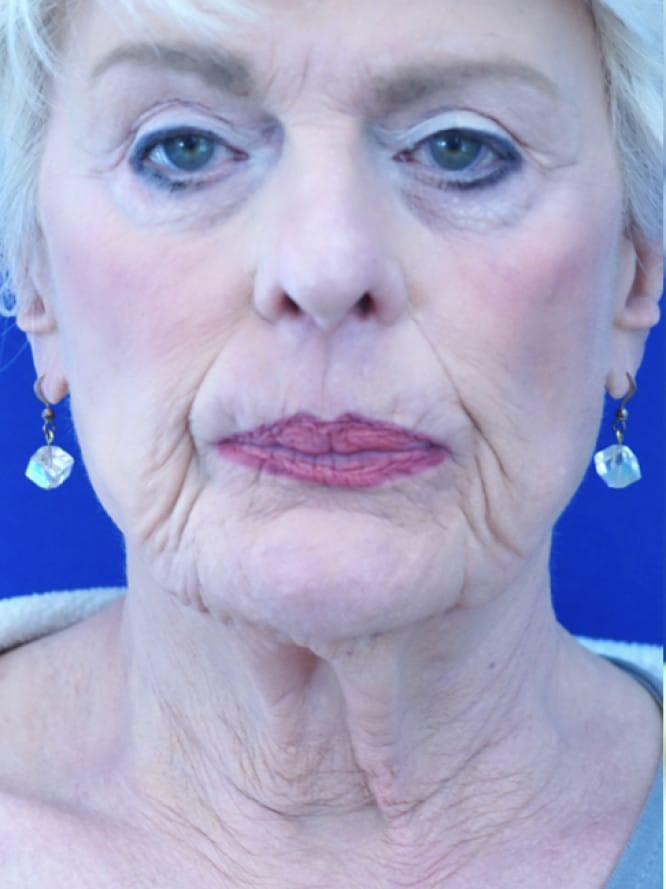 Deep Plane Lift and Platysmaplasty — Before