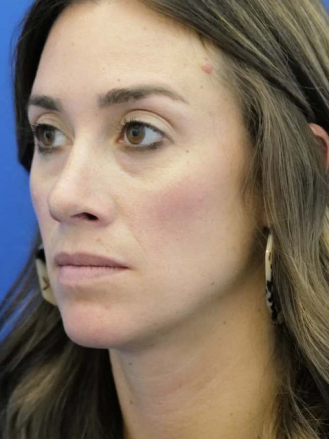 Preservation Rhinoplasty — After