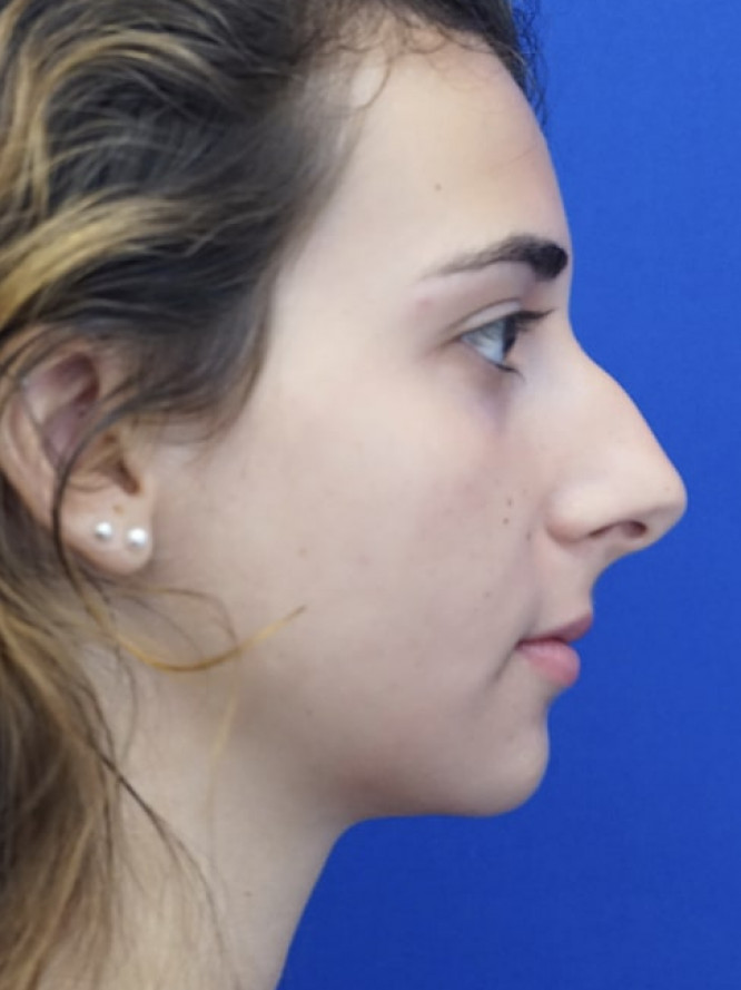 Classic Tension Nose — Before