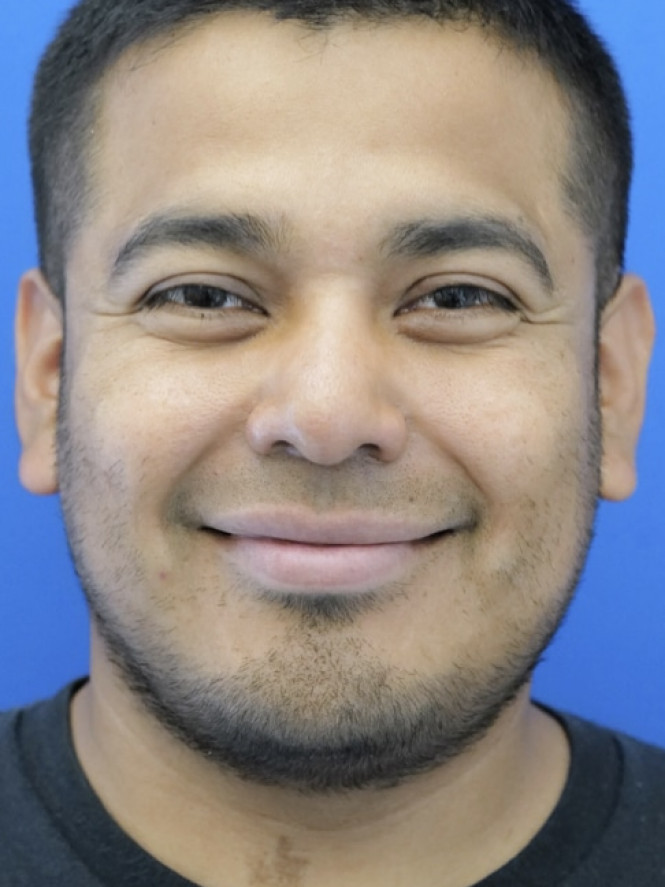 Rhinoplasty Trifecta — After