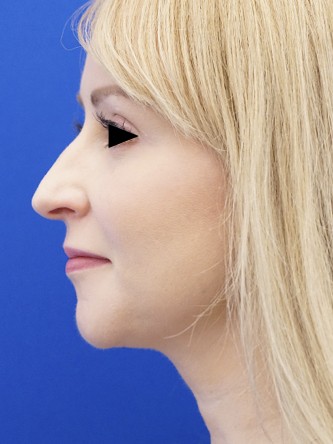 Nasal Profile Camouflage — Before