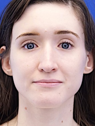 Nasal Profile Irregularity — Before