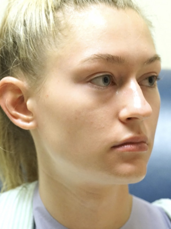 Nasal Profile Plasty — Before