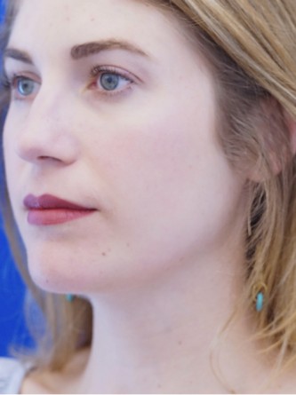 Chin LipoSculpture* — After