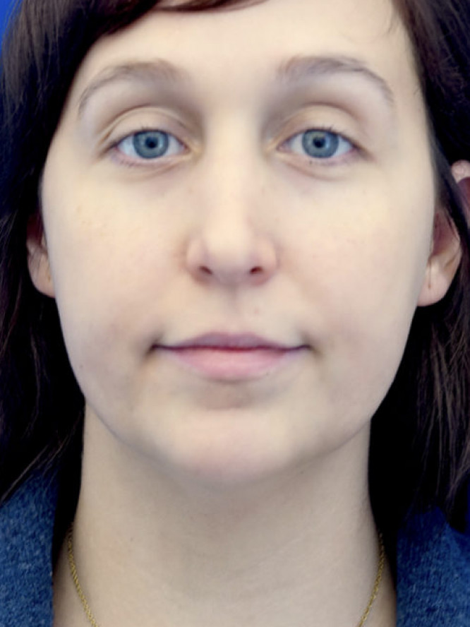 Necklift Subplatysmal Lipectomy — Before