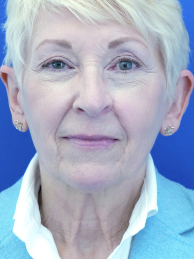 Deep Plane Naturale — Before