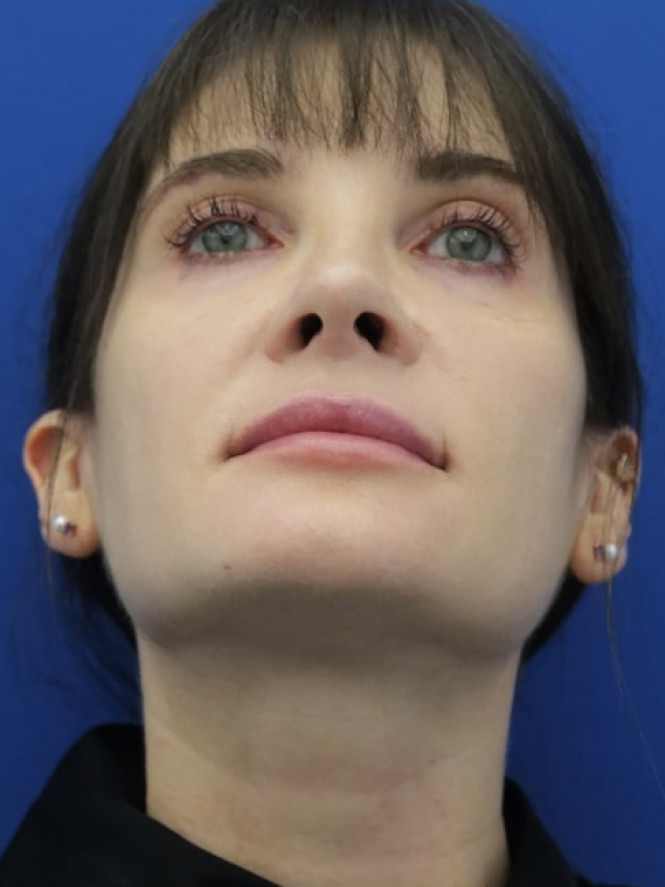 Preserving Tip Surface Aesthetics — After