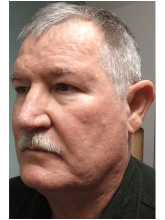 Aging Eyelid Rejuvenation, Facelift, Necklift 1* — Before