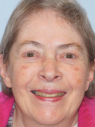 Visual Field Deficit – Eyelid Ptosis3* — After