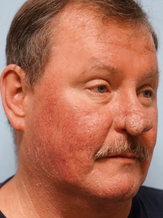 Rhinophyma* — Before