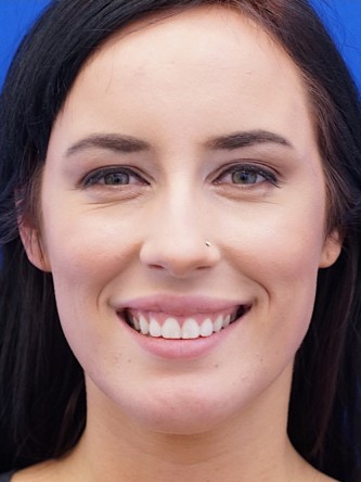 Chin Implant and Upper Lip Filler* — After