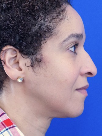 Ethnic Rhinoplasty* — Before
